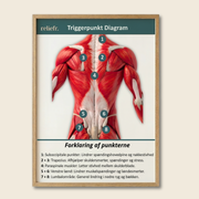 Trigger point diagram